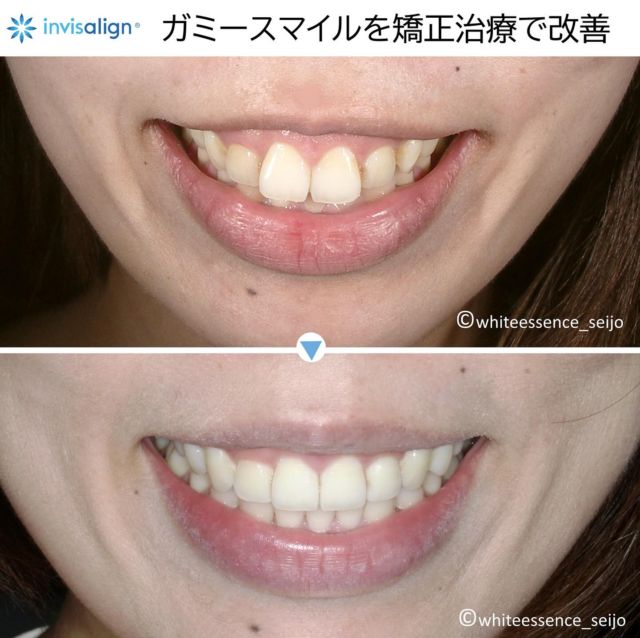 笑った時に、歯ぐきが大きく見える症状を「ガミースマイル」と呼びます。症状にもよりますが、インビザライン矯正のみでガミースマイルを改善することも可能ですので、同様の症状でお悩みの方は一度ご相談ください。
 
A “gummy smile” is a condition in which the gums appear larger when smiling. Depending on the symptoms, it is possible to improve a gummy smile only with Invisalign orthodontics, so please consult us if you suffer from similar symptoms.
 
#invisalign
#invisalignsmile
#インビザライン
#インビザライン矯正
#インビザライン矯正記録
#マウスピース矯正
#セラミック矯正
#裏側矯正
#矯正
#目立たない矯正
#見えない矯正
#歯列矯正
#矯正歯科
#矯正治療
#大人の矯正
#矯正日記
#歯並び
#出っ歯
#八重歯
#すきっ歯
#ガミースマイル
#Eライン
#横顔美人
#口ゴボ
#ダイエット
#白い歯
#ホワイトニング
#予防歯科
#矯正女子
#笑顔
#目立たない矯正
#見えない矯正